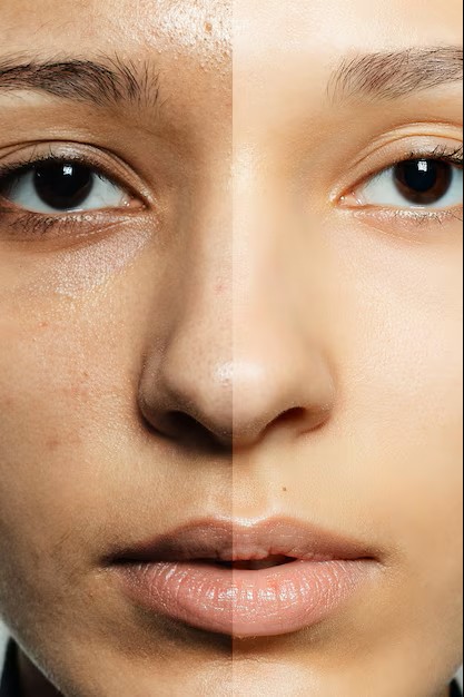 Healthy Beginnings Wellness|Facial Treatment (PDRN). 